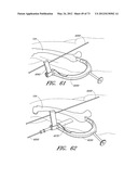 METHOD AND APPARATUS FOR HIP REPLACEMENT diagram and image