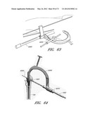 METHOD AND APPARATUS FOR HIP REPLACEMENT diagram and image