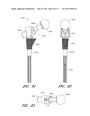 METHOD AND APPARATUS FOR HIP REPLACEMENT diagram and image