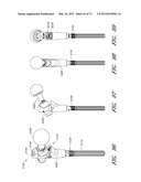 METHOD AND APPARATUS FOR HIP REPLACEMENT diagram and image