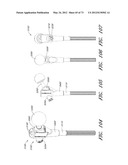 METHOD AND APPARATUS FOR HIP REPLACEMENT diagram and image