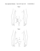 HIP JOINT DEVICE, SYSTEM AND METHOD diagram and image