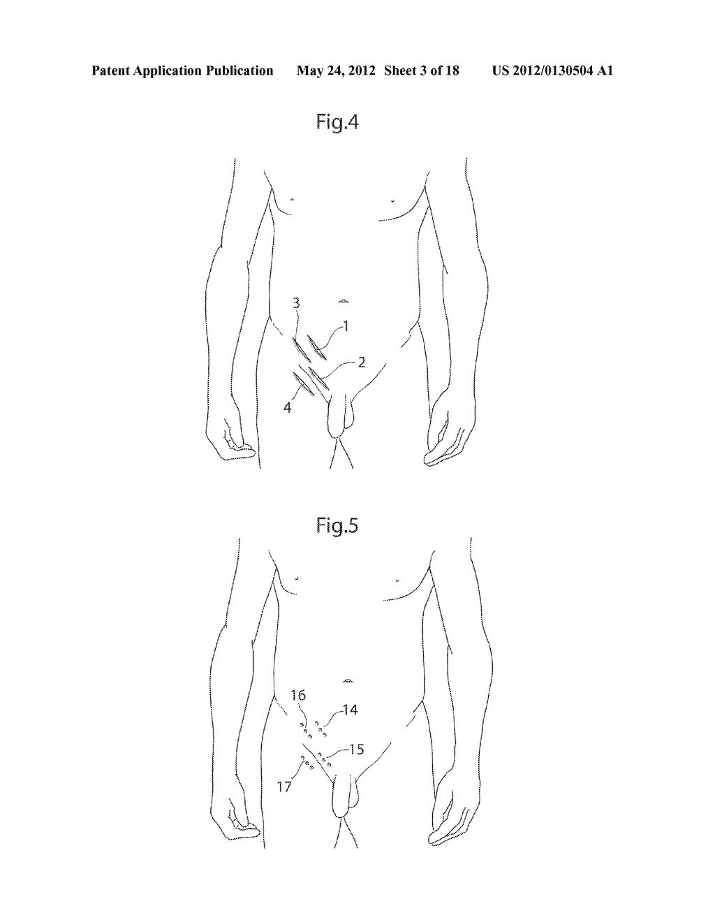 HIP JOINT DEVICE, SYSTEM AND METHOD - diagram, schematic, and image 04