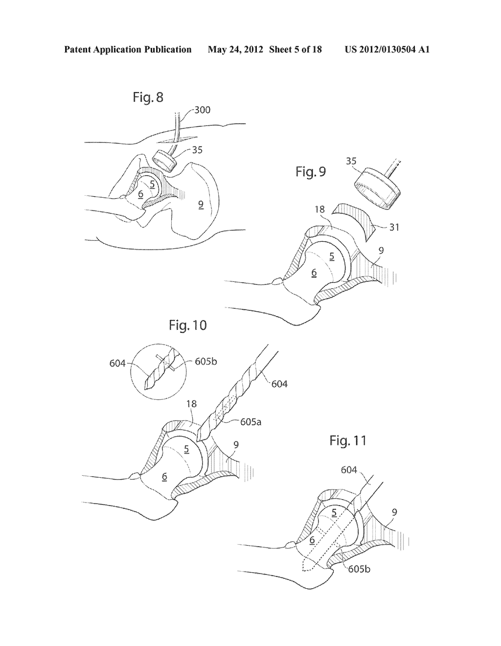 HIP JOINT DEVICE, SYSTEM AND METHOD - diagram, schematic, and image 06