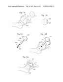 HIP JOINT DEVICE, SYSTEM AND METHOD diagram and image