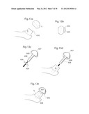 HIP JOINT DEVICE, SYSTEM AND METHOD diagram and image