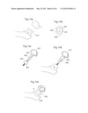 HIP JOINT DEVICE, SYSTEM AND METHOD diagram and image