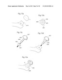 HIP JOINT DEVICE, SYSTEM AND METHOD diagram and image