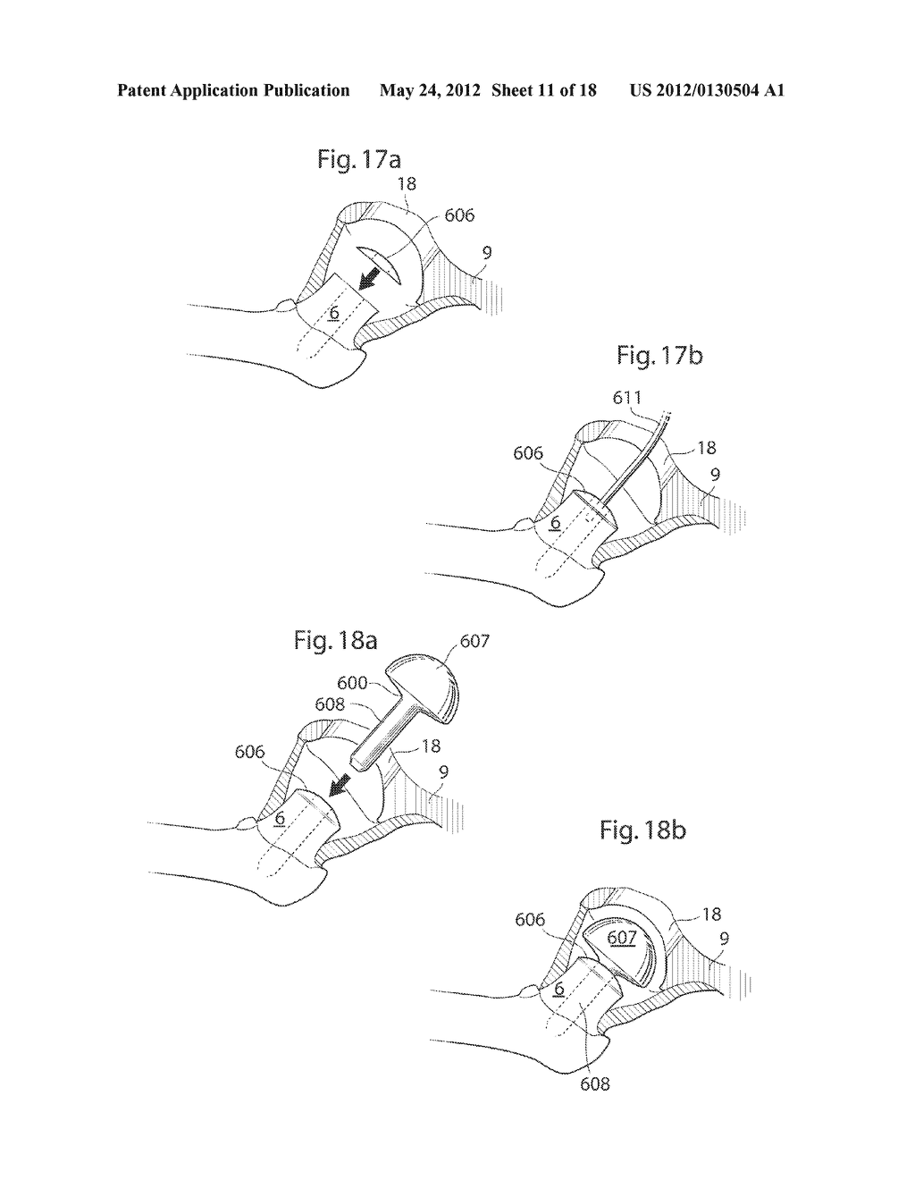 HIP JOINT DEVICE, SYSTEM AND METHOD - diagram, schematic, and image 12