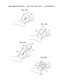 HIP JOINT DEVICE, SYSTEM AND METHOD diagram and image