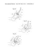 HIP JOINT DEVICE, SYSTEM AND METHOD diagram and image