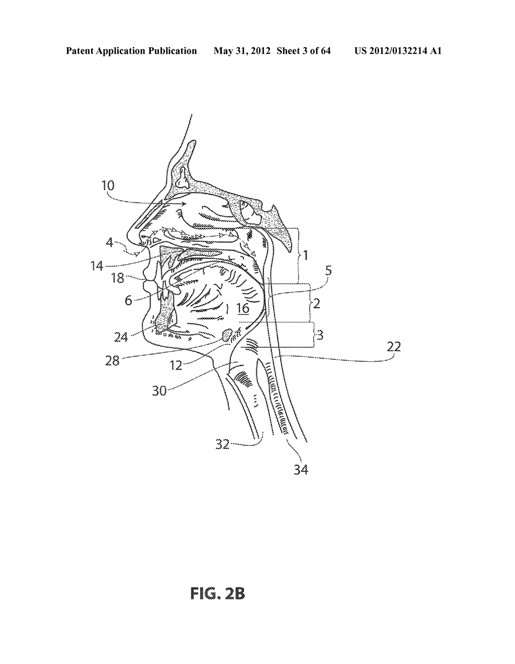 SYSTEMS AND METHODS FOR TREATMENT OF SLEEP APNEA - diagram, schematic, and image 04