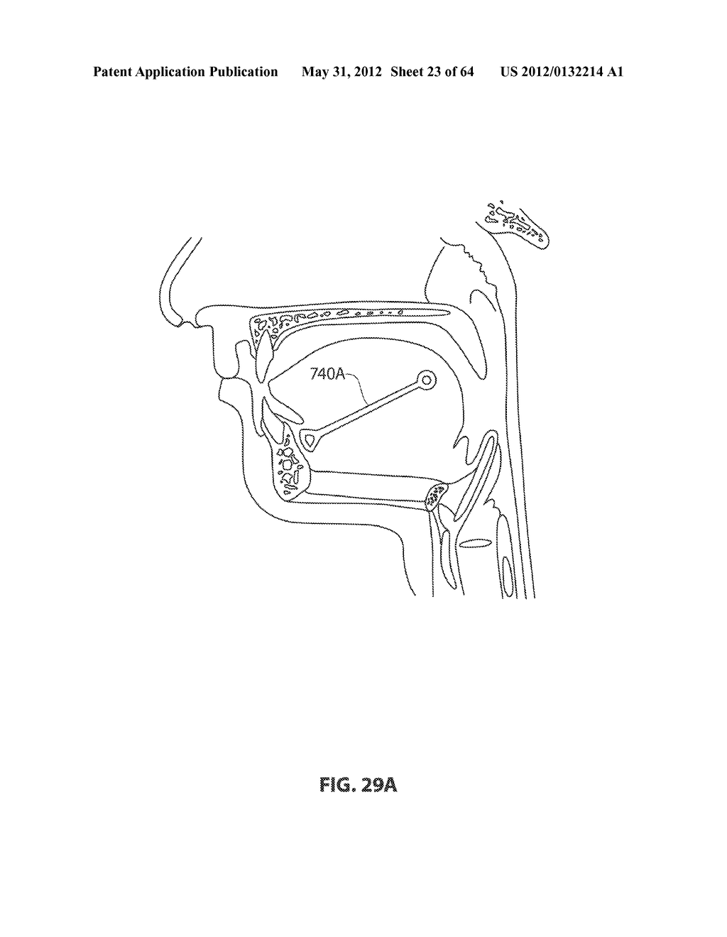 SYSTEMS AND METHODS FOR TREATMENT OF SLEEP APNEA - diagram, schematic, and image 24