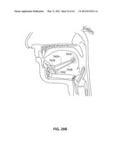 SYSTEMS AND METHODS FOR TREATMENT OF SLEEP APNEA diagram and image