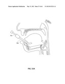 SYSTEMS AND METHODS FOR TREATMENT OF SLEEP APNEA diagram and image