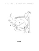 SYSTEMS AND METHODS FOR TREATMENT OF SLEEP APNEA diagram and image