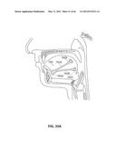 SYSTEMS AND METHODS FOR TREATMENT OF SLEEP APNEA diagram and image