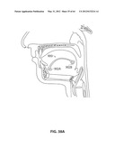 SYSTEMS AND METHODS FOR TREATMENT OF SLEEP APNEA diagram and image