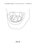 SYSTEMS AND METHODS FOR TREATMENT OF SLEEP APNEA diagram and image