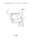 SYSTEMS AND METHODS FOR TREATMENT OF SLEEP APNEA diagram and image