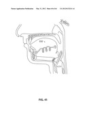 SYSTEMS AND METHODS FOR TREATMENT OF SLEEP APNEA diagram and image