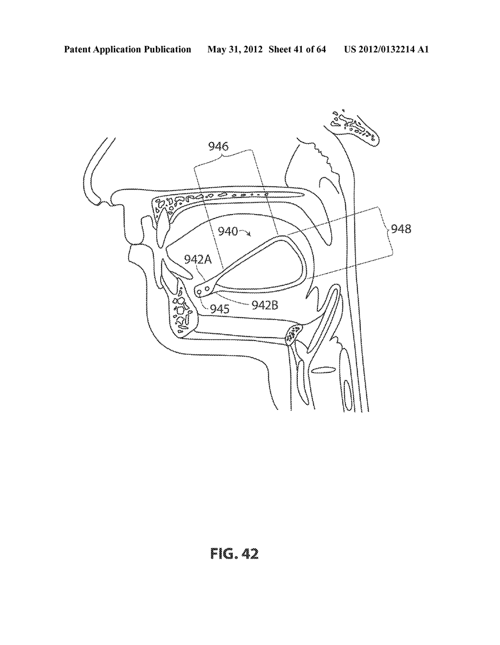 SYSTEMS AND METHODS FOR TREATMENT OF SLEEP APNEA - diagram, schematic, and image 42