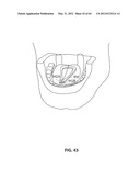 SYSTEMS AND METHODS FOR TREATMENT OF SLEEP APNEA diagram and image