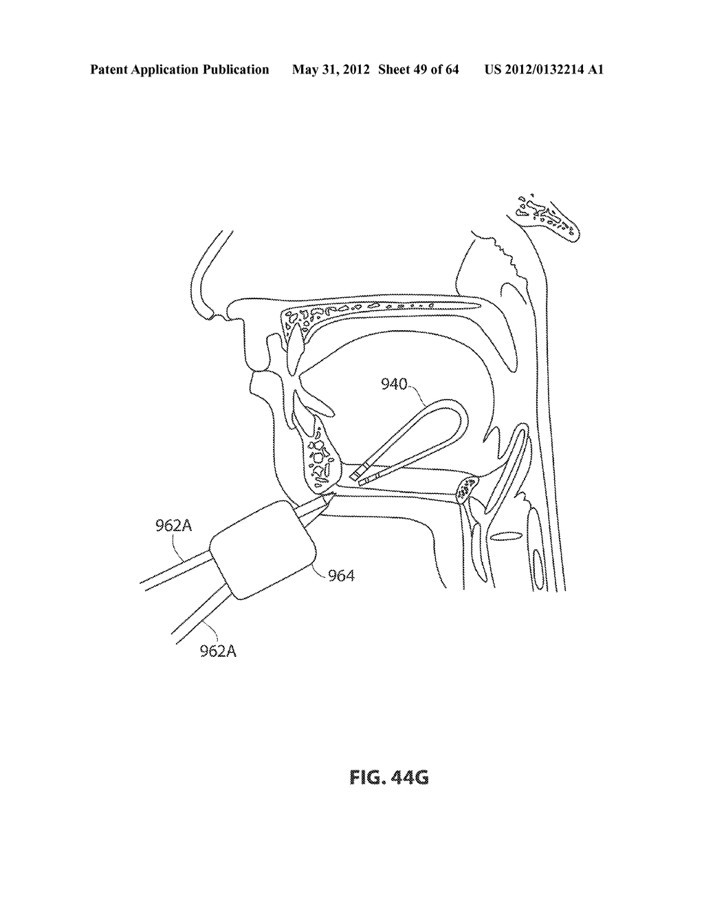 SYSTEMS AND METHODS FOR TREATMENT OF SLEEP APNEA - diagram, schematic, and image 50