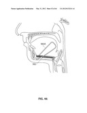 SYSTEMS AND METHODS FOR TREATMENT OF SLEEP APNEA diagram and image