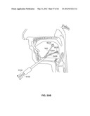 SYSTEMS AND METHODS FOR TREATMENT OF SLEEP APNEA diagram and image