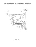 SYSTEMS AND METHODS FOR TREATMENT OF SLEEP APNEA diagram and image