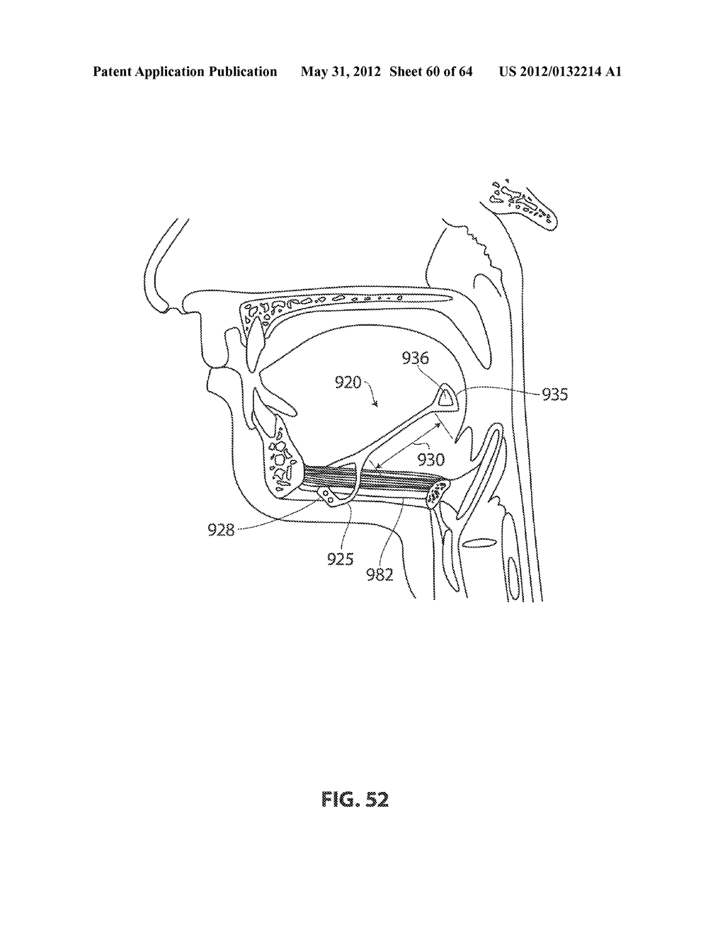 SYSTEMS AND METHODS FOR TREATMENT OF SLEEP APNEA - diagram, schematic, and image 61