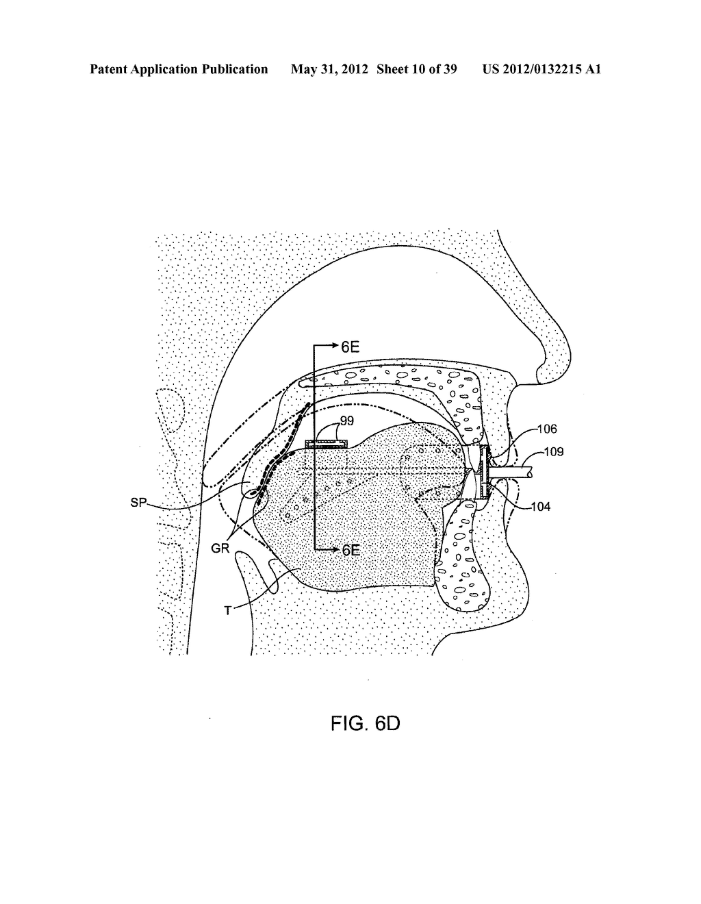 METHODS AND SYSTEMS FOR IMPROVING AIRWAY PATENCY - diagram, schematic, and image 11