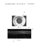 TEAR FILM AND TEAR MENISCUS DYNAMICS WITH TIME-LAPSE OPTICAL COHERENCE     TOMOGRAPHY diagram and image