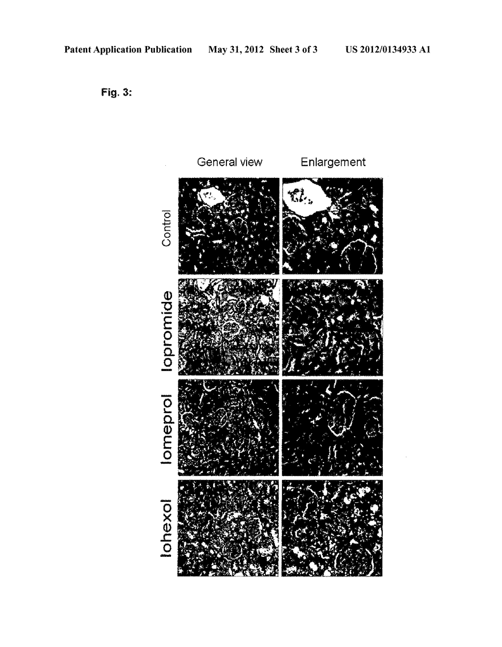 USE OF HIGH-DOSES OF MONOMERIC CONTRAST MEDIUM CONTAINING IODINE IN X-RAY     DIAGNOSTICS, IN PARTICULAR IN INTERVENTIONAL X-RAY DIAGNOSTICS AND IN     RADIATION THERAPY ASSISTED BY CONTRAST MEDIA CONTAINING IODINE - diagram, schematic, and image 04