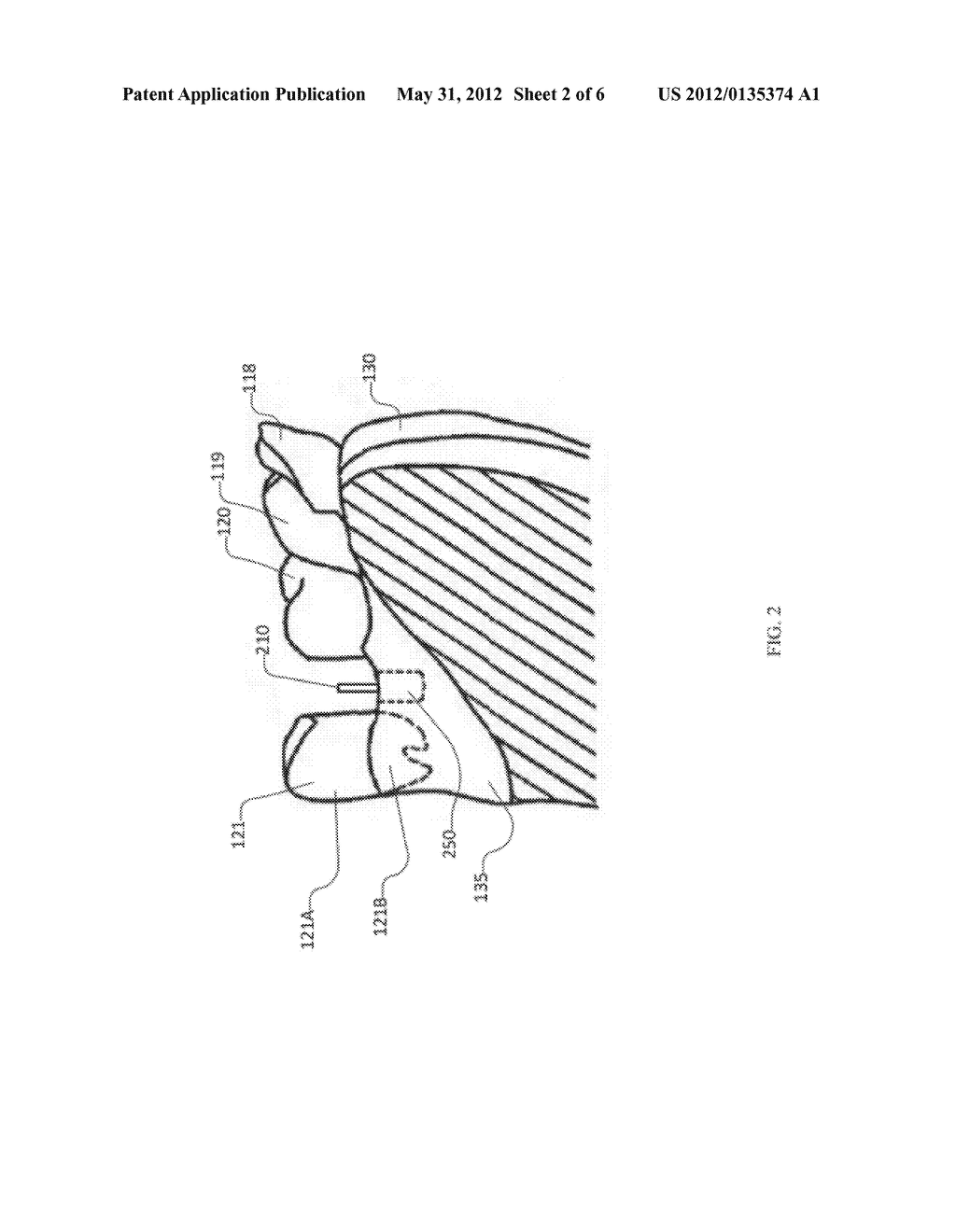 Emergence Profile Guide for a Dental Bur - diagram, schematic, and image 03