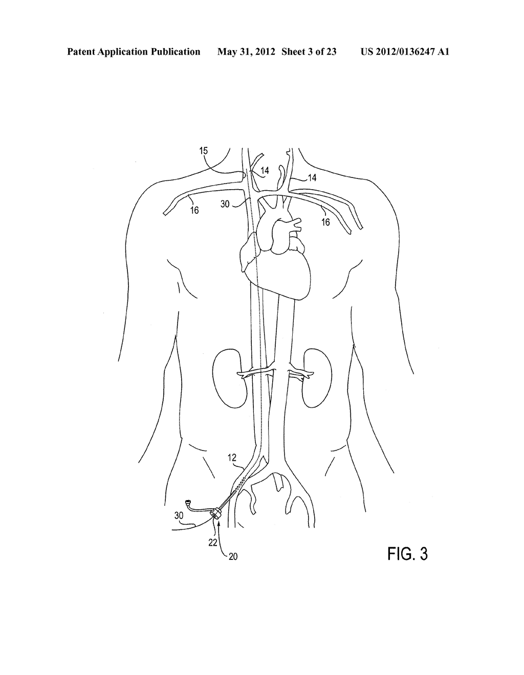 Methods of Transvascular Retrograde Access Placement and Devices for     Facilitating the Placement - diagram, schematic, and image 04