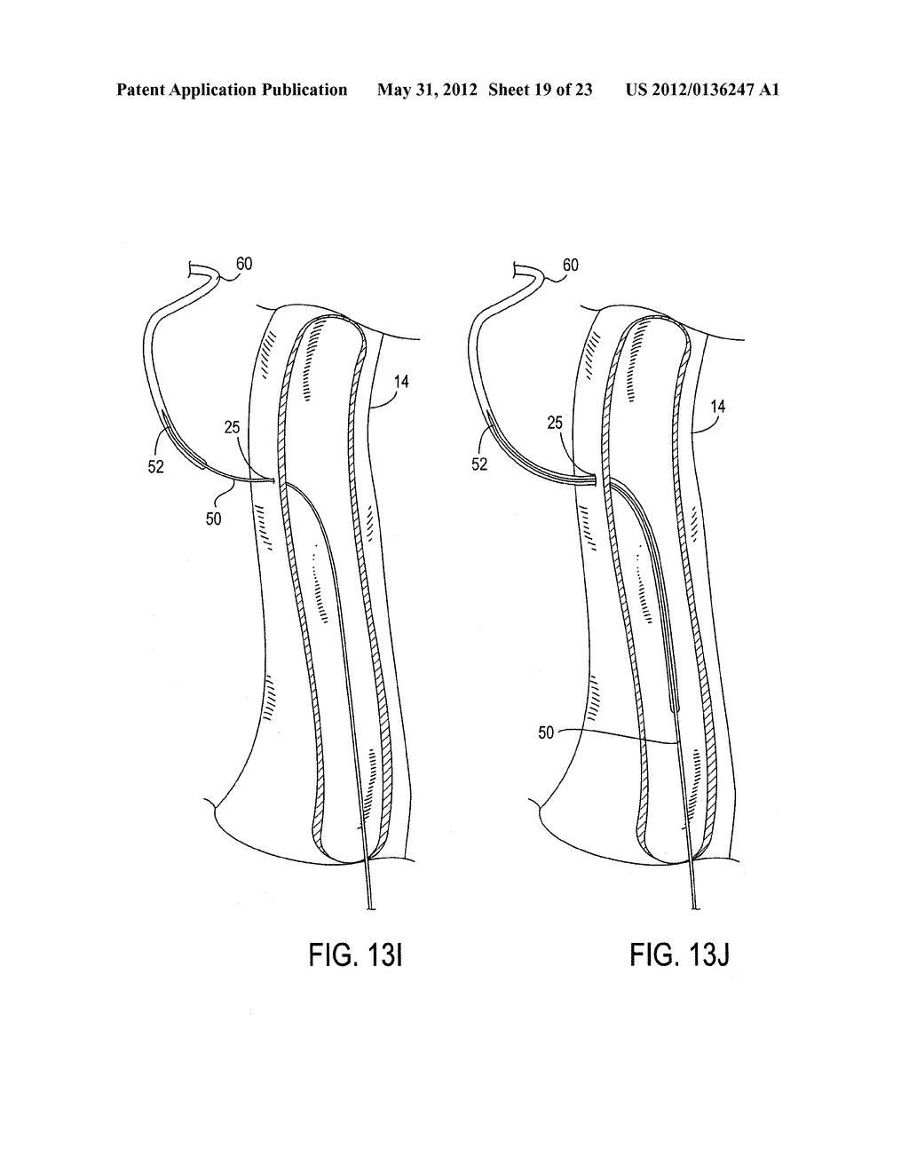 Methods of Transvascular Retrograde Access Placement and Devices for     Facilitating the Placement - diagram, schematic, and image 20