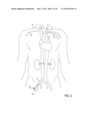 Methods of Transvascular Retrograde Access Placement and Devices for     Facilitating the Placement diagram and image