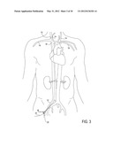 Methods of Transvascular Retrograde Access Placement and Devices for     Facilitating the Placement diagram and image