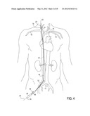 Methods of Transvascular Retrograde Access Placement and Devices for     Facilitating the Placement diagram and image