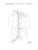 Methods of Transvascular Retrograde Access Placement and Devices for     Facilitating the Placement diagram and image