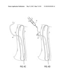 Methods of Transvascular Retrograde Access Placement and Devices for     Facilitating the Placement diagram and image