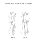 Methods of Transvascular Retrograde Access Placement and Devices for     Facilitating the Placement diagram and image