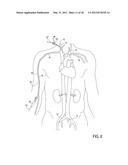 Methods of Transvascular Retrograde Access Placement and Devices for     Facilitating the Placement diagram and image