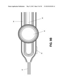 Methods of Transvascular Retrograde Access Placement and Devices for     Facilitating the Placement diagram and image