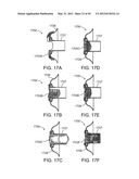 OSTOMY CONTAINMENT DEVICE diagram and image