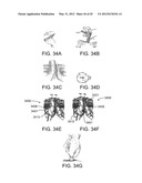 OSTOMY CONTAINMENT DEVICE diagram and image