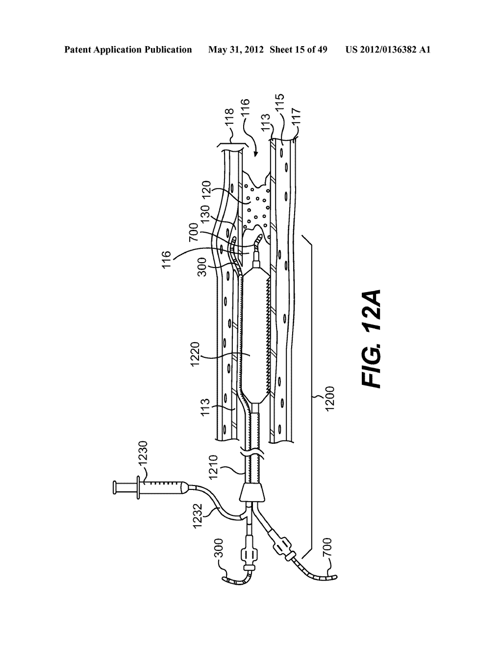 ENDOVASCULAR DEVICES AND METHODS FOR EXPLOITING INTRAMURAL SPACE - diagram, schematic, and image 16