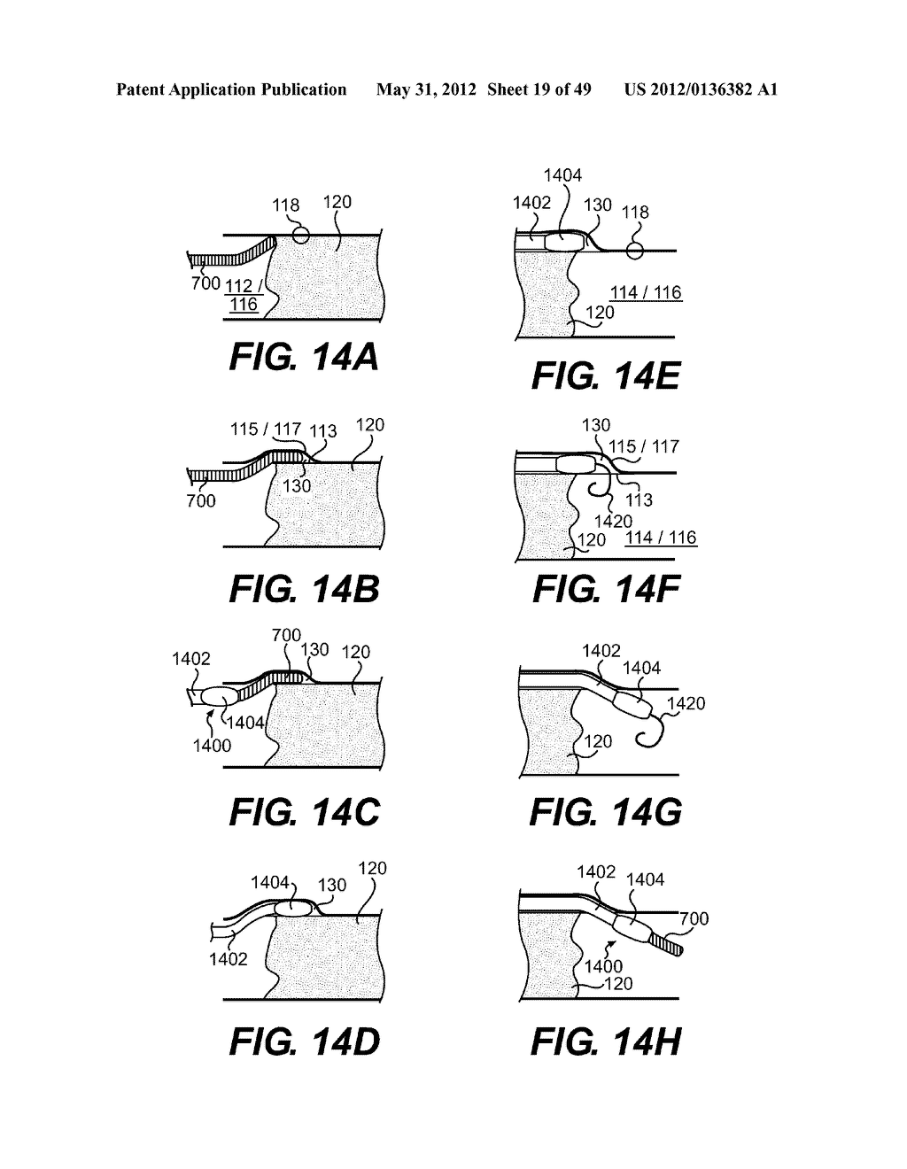 ENDOVASCULAR DEVICES AND METHODS FOR EXPLOITING INTRAMURAL SPACE - diagram, schematic, and image 20